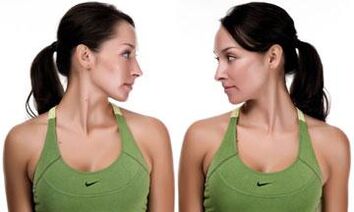 Ασκήσεις για αυχενική οστεοχονδρωσία για αποτελεσματική αντιμετώπιση της νόσου